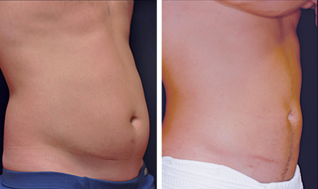 Smart Lipo Before and After Pictures